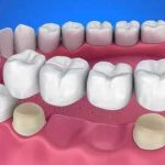 Sabit protez diş fiyatları